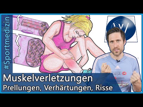 Muskelverletzung: Alles über Muskelprellung über Muskelzerrung bis Muskelfaserriss! PECH-Regel