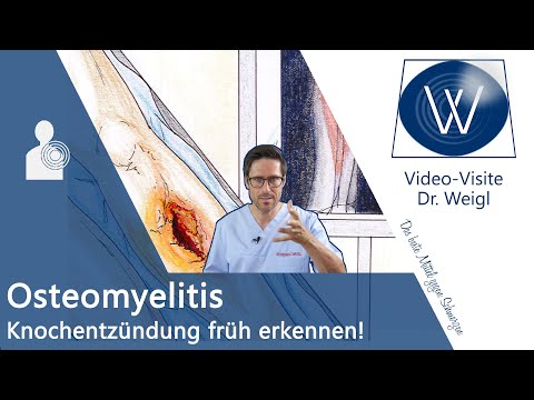 Osteomyelitis: Was passiert wenn der Knochen schmerzt &amp; sich entzündet (nach OP oder Knochenbruch)?