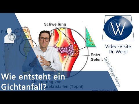 Gicht 😡 Oft unterschätzt aber sehr schmerzhaft: Akuter Gichtanfall - Ursachen, Symptome &amp; Therapie