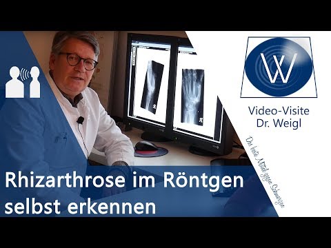 Fingerarthrose &amp; Daumenarthrose im Röntgen selber erkennen🤓 Diagnostik &amp; Radiologie Rhizarthrose