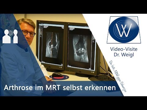 Knieschmerzen, Knieverletzung &amp; Kniearthrose im MRT - Diagnose Arthrose, Kreuzbandriss, Meniskus