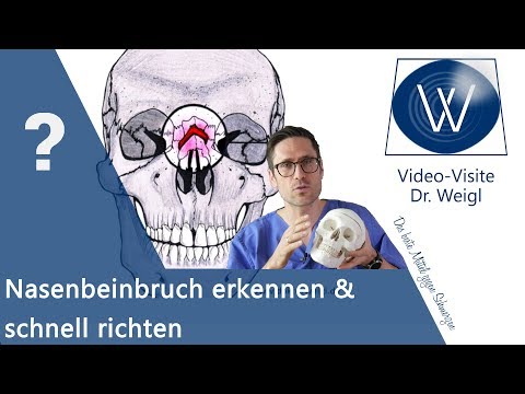 Nasenbeinbruch erkennen &amp; richtig richten - Sofortmaßnahmen bei gebrochener Nase und Nasenbluten