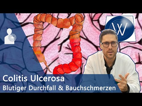 Colitis Ulcerosa: Bauchschmerz &amp; schleimig blutiger Durchfall? Hilfe bei Chronischer Darmerkrankung