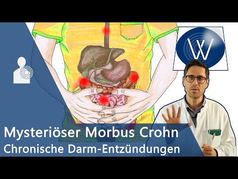 Morbus Crohn: Ursache für unblutigen Durchfall &amp; Bauchschmerz? Chronisch-entzündliche Darmerkrankung