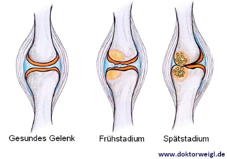 Arthrose: Behandlung und Symptome von Gelenkverschleiß