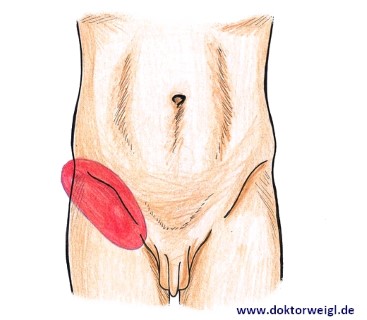 DoktorWeigl erklärt Leistenschmerzen