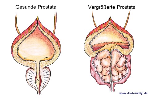 gâdilă prostatită)