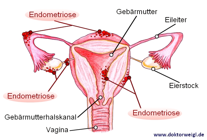 Endometriose